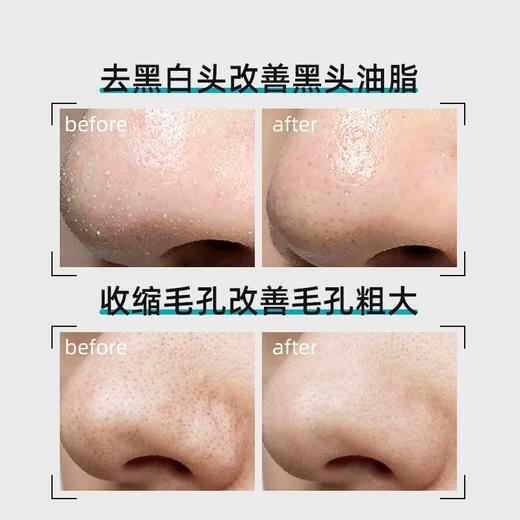 ilso一苏黑头导出精华液套装（黑头导出精华液150ml+黑头铲+湿敷棉50枚） 商品图5