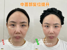【王雯婷】院长-中面部复位提升