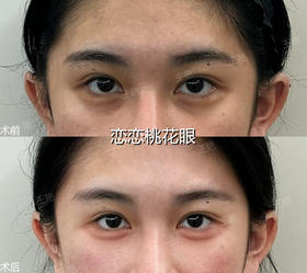 【王艳】-卧蚕案例