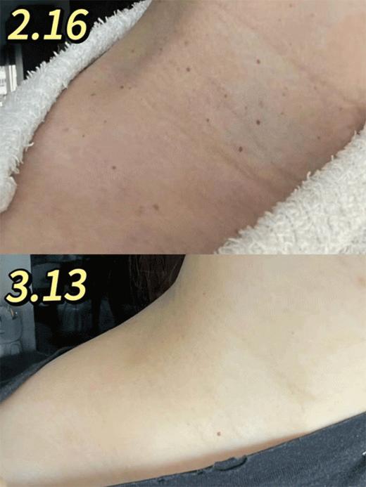 ✨疣体橡皮擦🔥祛疣无感无巴👍 【香巷🇭🇰宝芝林-草本克尤保建膏】 扁平疣·丝状疣·跖疣·都能用❗️❗️ 商品图2