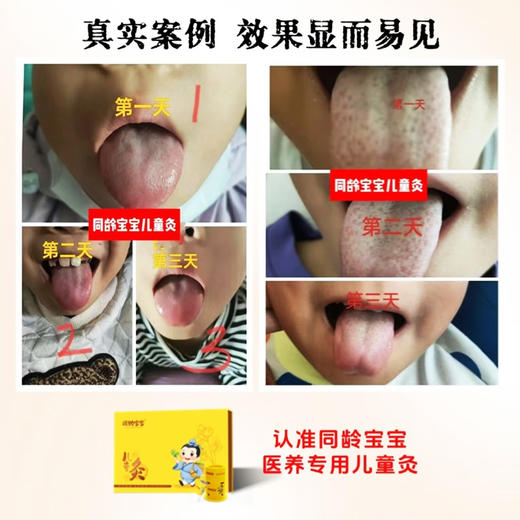同龄宝宝儿童艾灸 商品图3