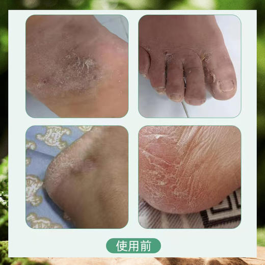 【陈沅堂抑菌液赠真菌快克】真菌困扰救星！ 专攻脚气脱皮瘙痒 草本温和根治 180ml/瓶（2.7-2.22停发） 商品图4