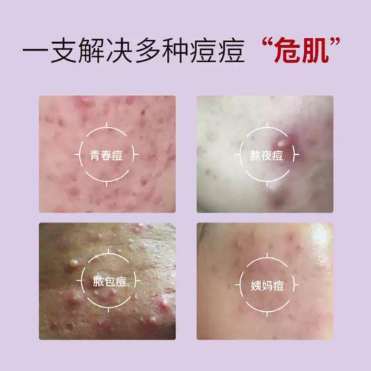 纤芳集透悦苍术祛痘修护凝胶20g 商品图3